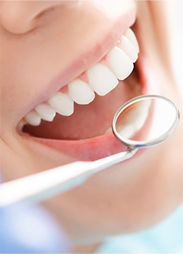 ESZTÉTIKUS KORONÁK