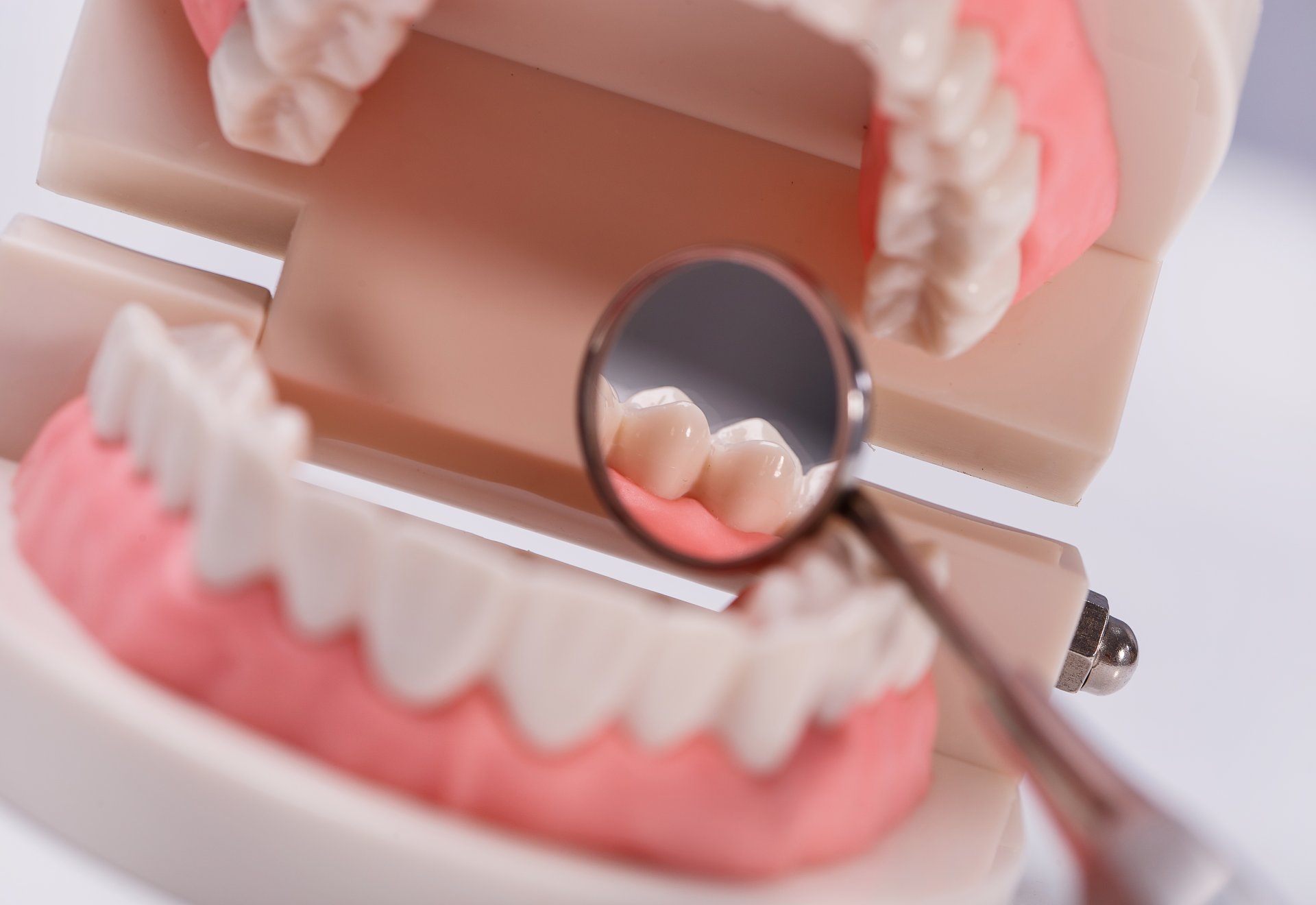 Mikor jobb a hídnál az implantátum? Foghíd vagy implantátum? Mikor melyik jobb választás? | DentExpert