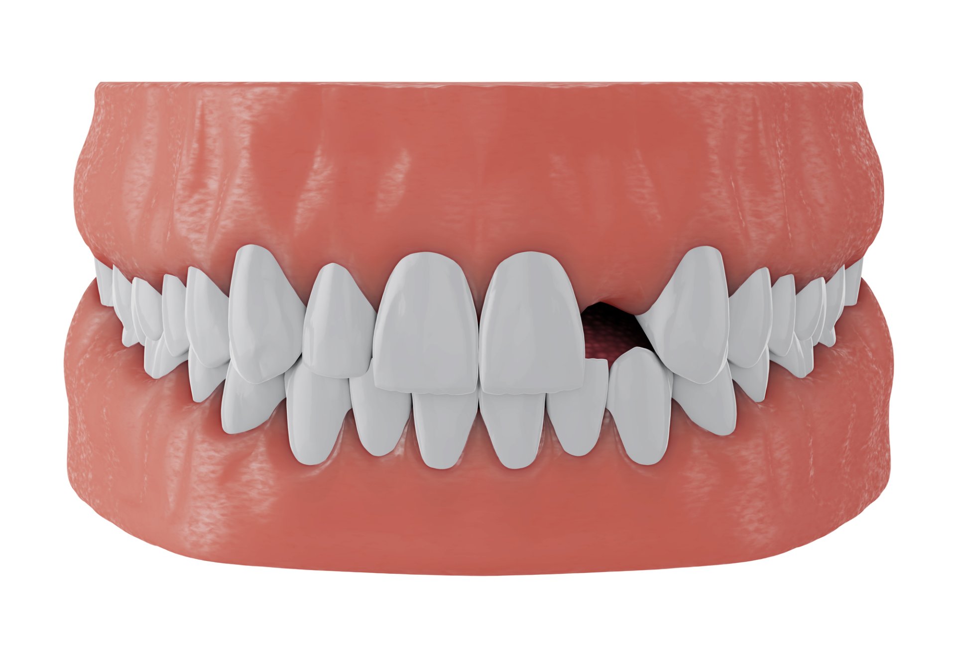 Mit tegyek, ha hiányzik egy fogam?