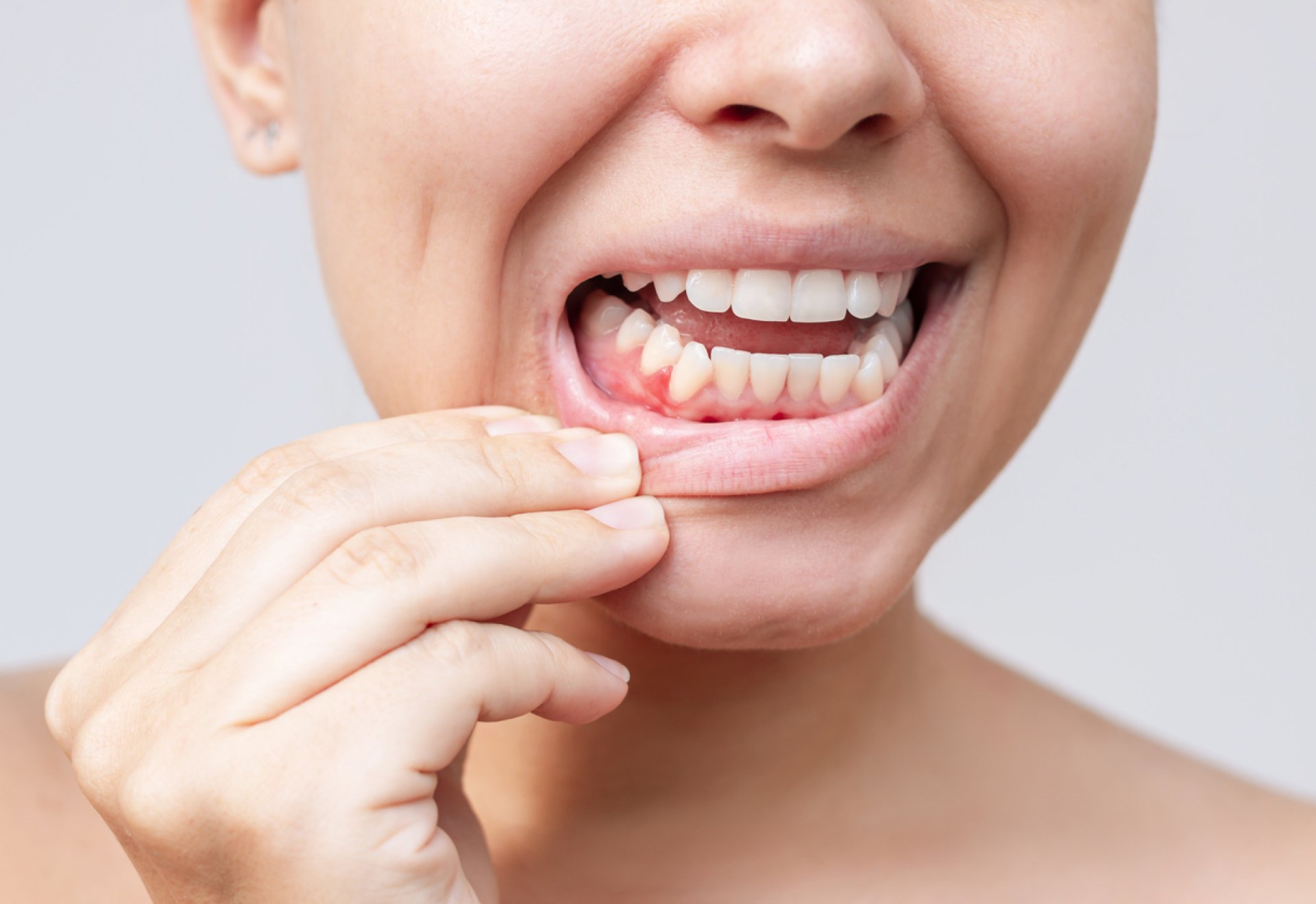 Fogínygyulladás tünetei – Így ismerheted fel a gingivitist