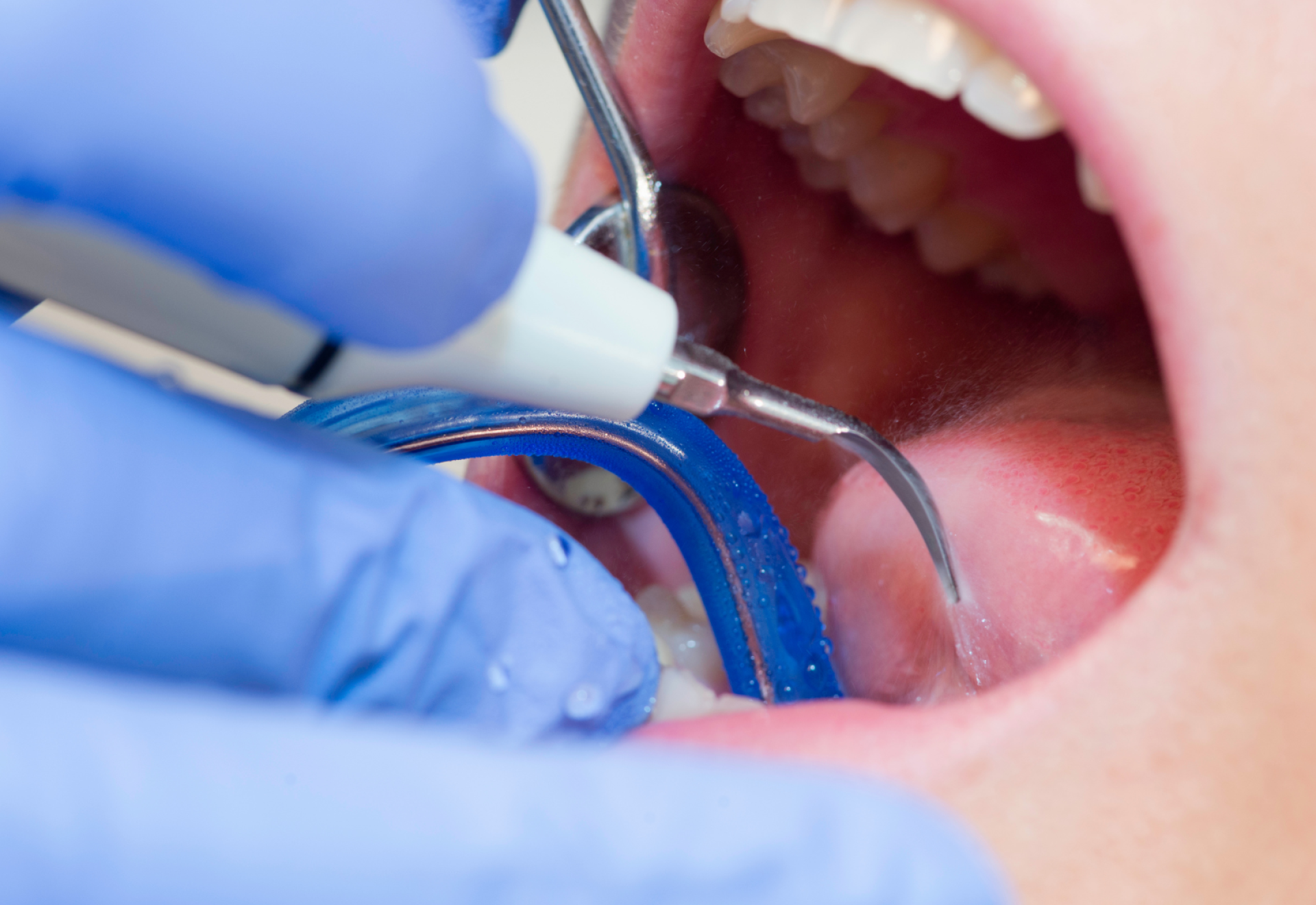 A fogkő veszélyei – amikor már nem csak esztétikai probléma