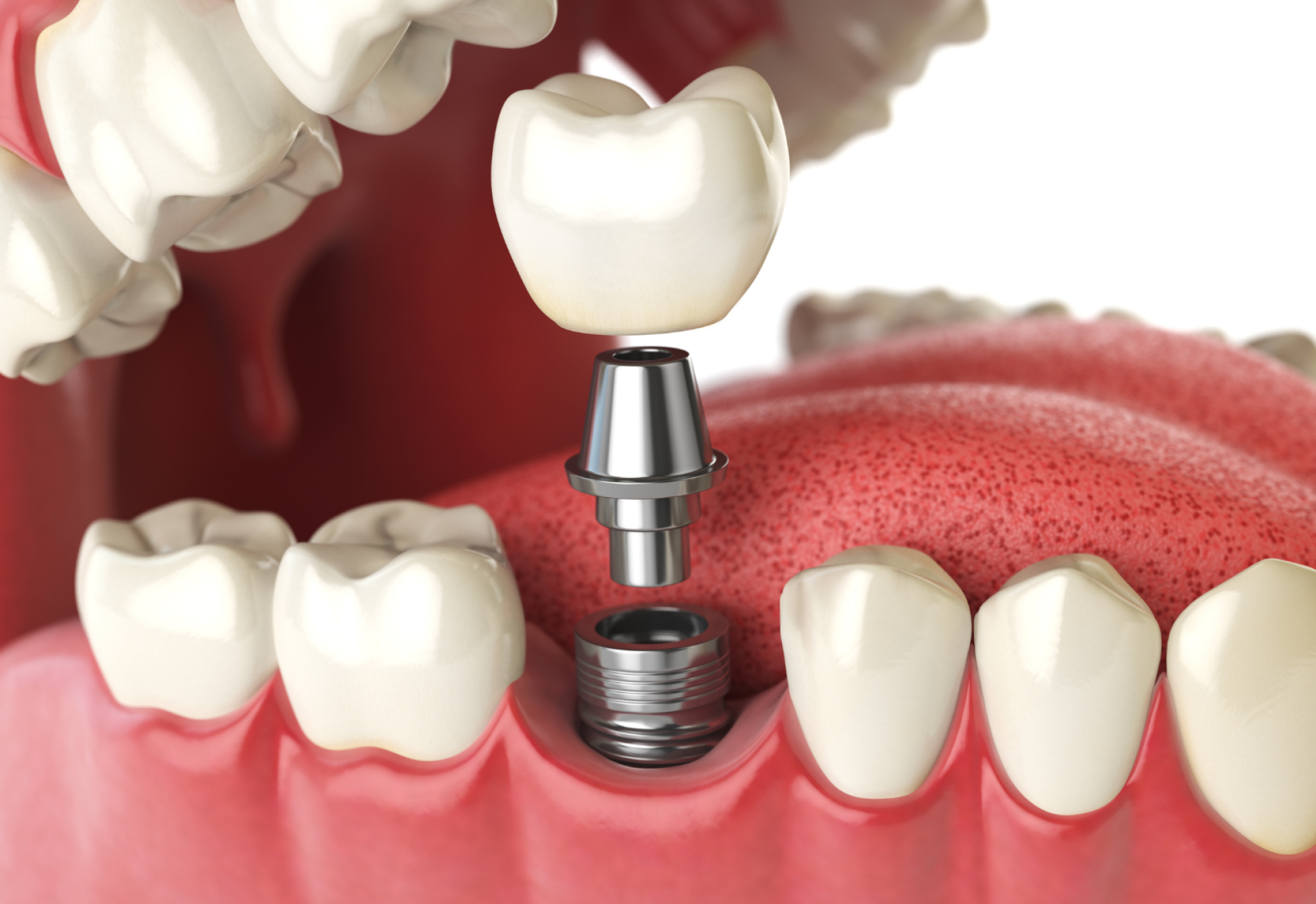 A legjobb fogimplantátum Győrben