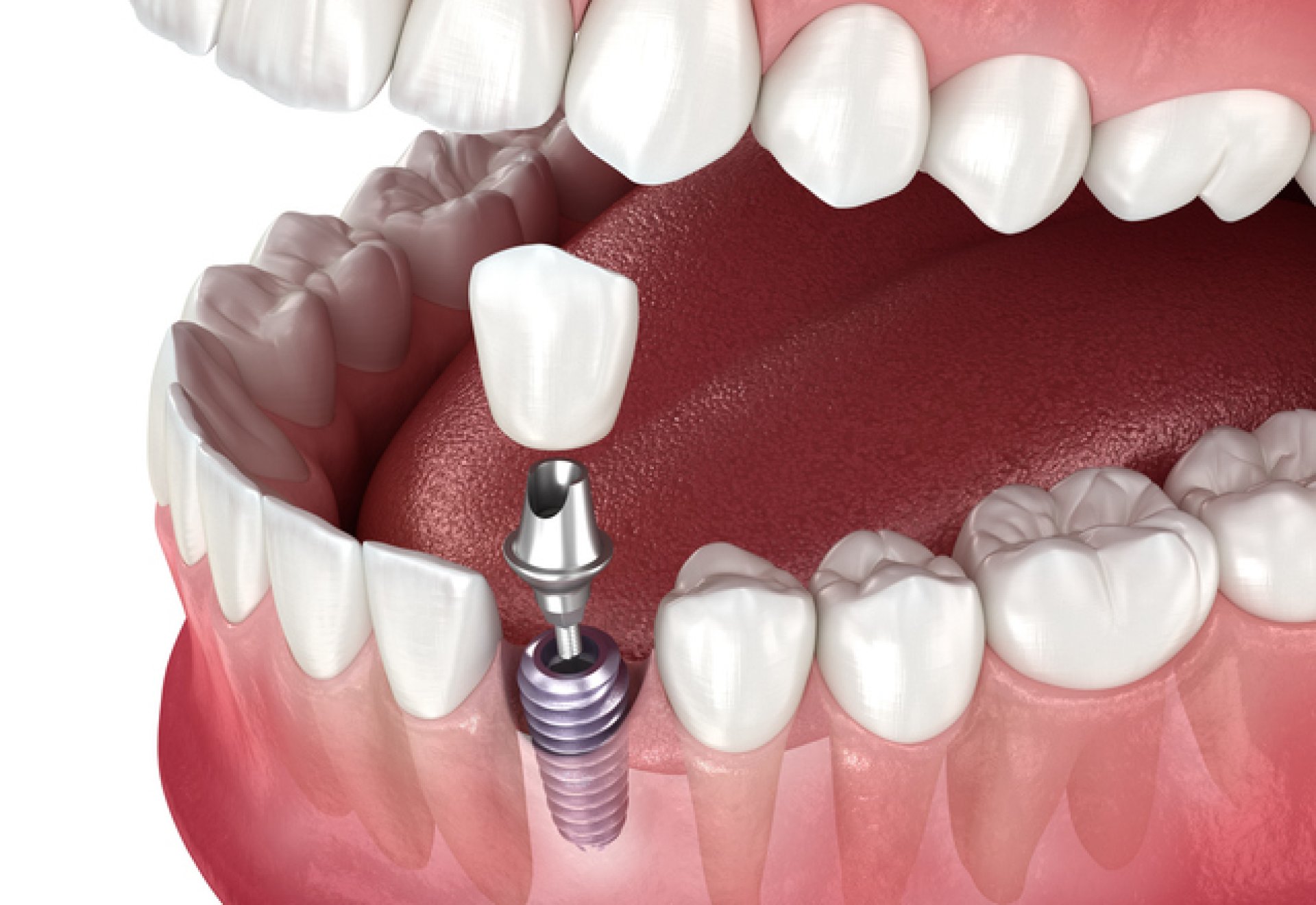 Fogimplantátum részletre