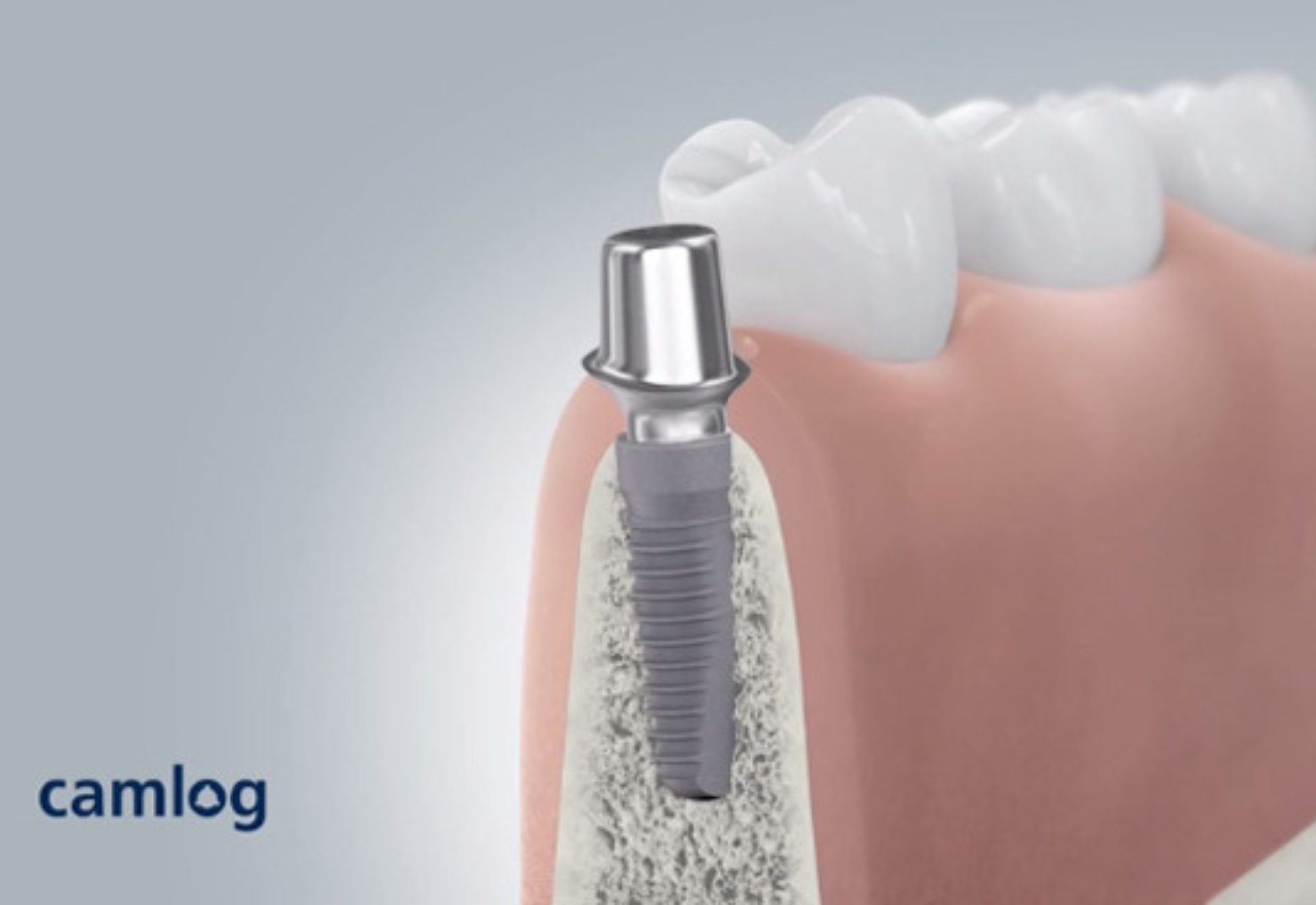 Prémium CAMLOG implantátum