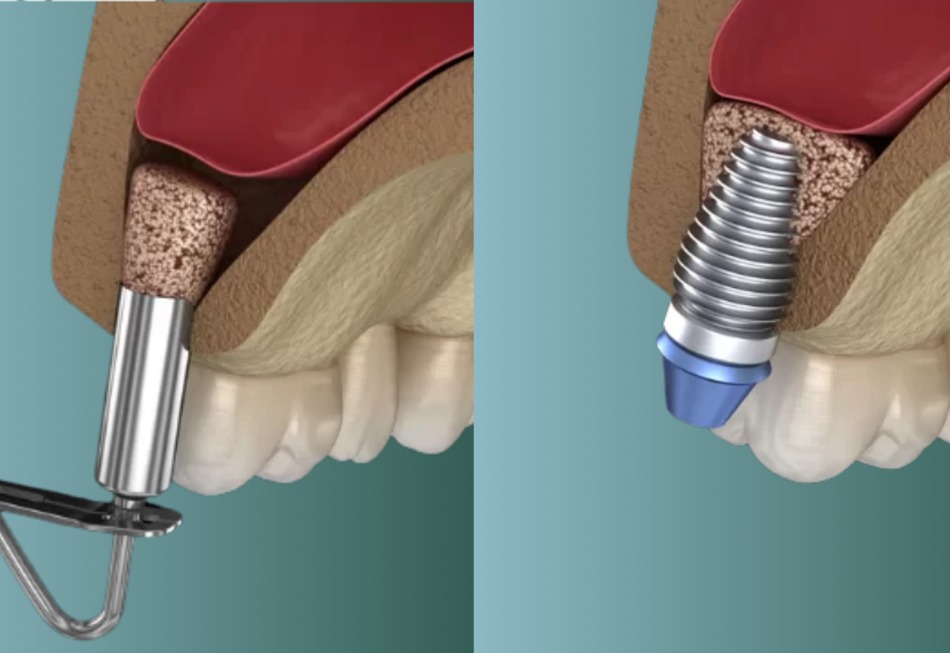 Arcüregemelés (sinus lift) 