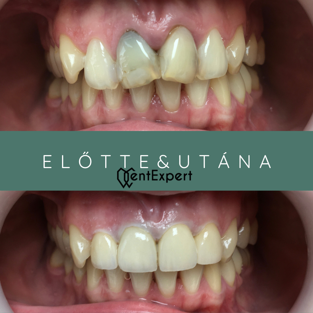 Cirkon korona alkamazása