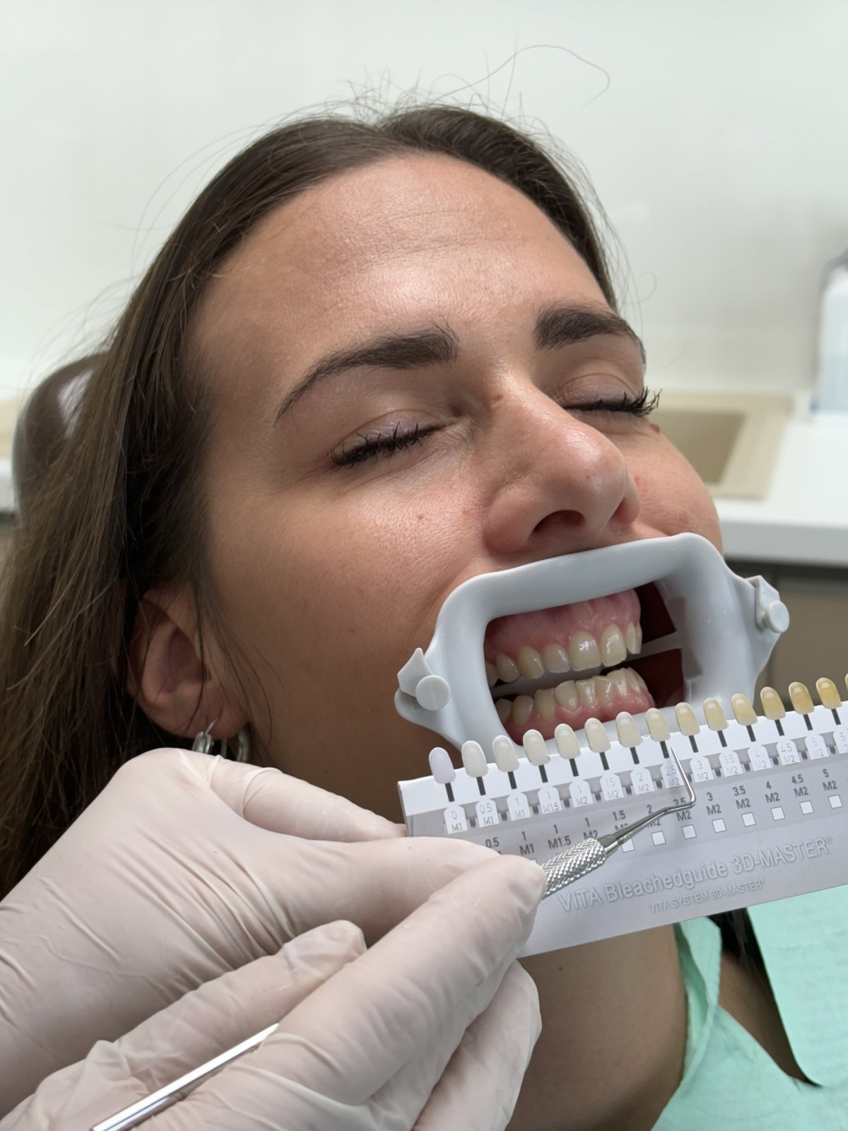 Fogfehérítés Győrben